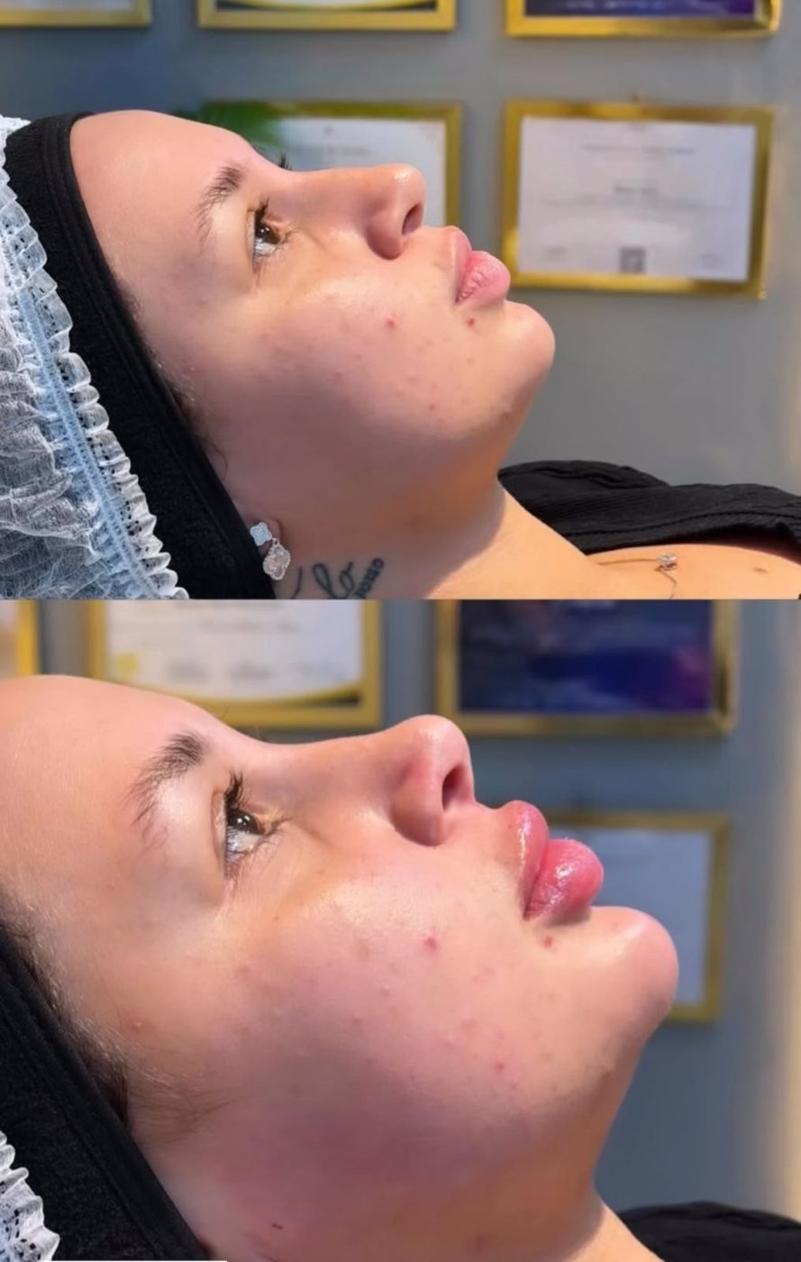 Perfiloplastia — resultado 4, antes e depois